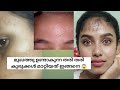 14 days challenge / How to Remove Tiny bumps at home / tiny bumps malayalam / glamyganga