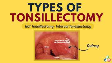 Tonsillectomy Types | Hot Tonsillectomy | Interval Tonsillectomy
