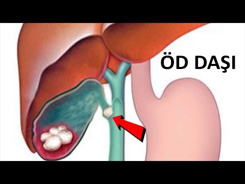 Video: Öd kisəsindəki daşları nə vaxt çıxarmaq lazımdır?