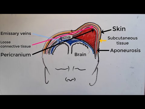 Video: Cephalohematom Hos Nyfødte