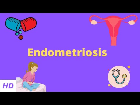 Endometriosis, Causes, Signs and Symptoms, Diagnosis and Treatment.