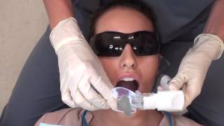 iLight Suction: Placing the iLight Suction into the Mouth