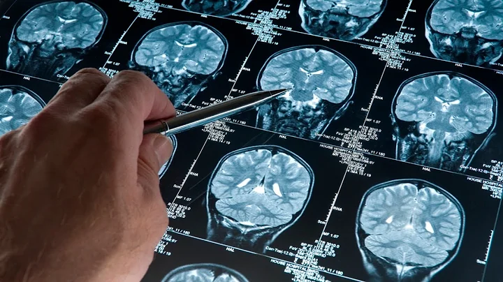 Breakthrough in therapy to treat Parkinsons disease