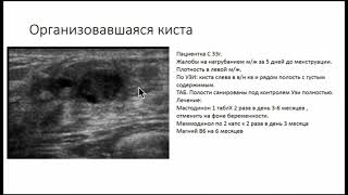 Организовавшаяся Киста Молочной Железы