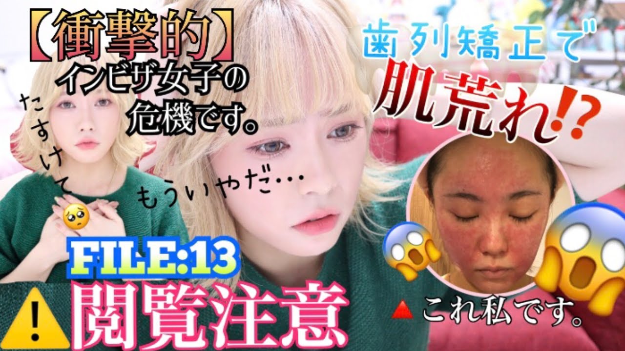 【肌荒れ】と【歯列矯正】食事中の人はきっと見ないほうがいいお【閲覧注意報】