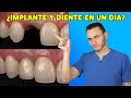 Implantes y dientes en un sólo día ¿Realidad o Engaño?