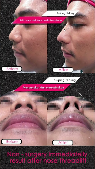 Lelaki Hidung Mancung - Non-Surgery Immediately Result After Nose Thread Lift