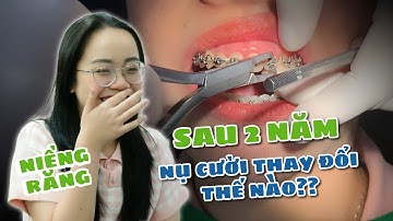 Em Gái 15 Tuổi Răng Hô Và Lệch Mặt Và Kết Quả Sau 2 Năm Niềng Răng