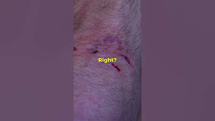 Aggressive Dachshund Bites Cesar During Training #dogwhisperer #dog #cesarmillan