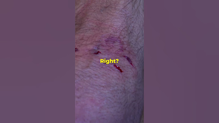 Aggressive Dachshund Bites Cesar During Training #dogwhisperer #dog #cesarmillan