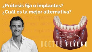 Implantes dentales vs. prótesis dental