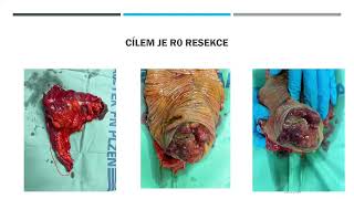 Zásady chirurgické terapie nádorových onemocnění - prof. MUDr. J. Moláček, Ph.D.