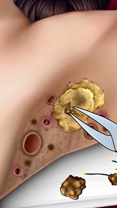 ASMR Cleaning Ingrown Armpit Hair #shorts #asmr #animation #relax #satisfying #armpit #ingrownhair