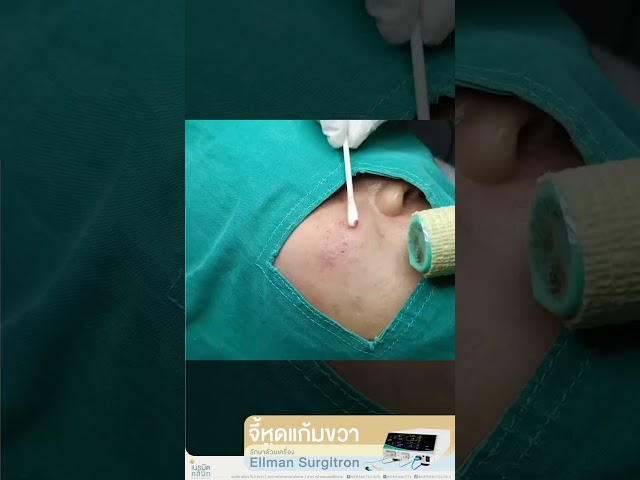 จี้หูดแก้มขวา