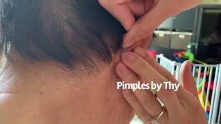 Popping Huge Blackhead Behind Ear