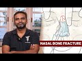 Nasal bone fracture   dr sree charan