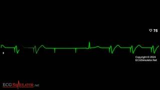 Pacemaker V Failure To Capture