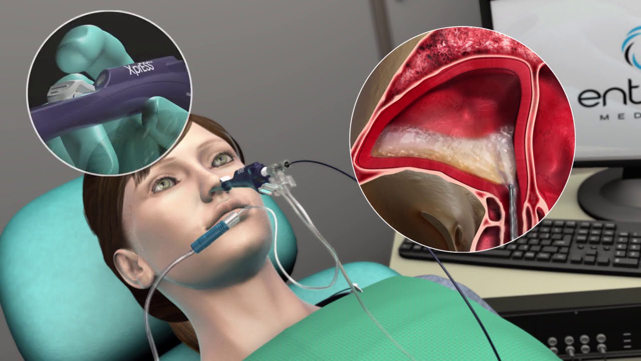 XprESS LF | Balloon Sinuplasty Procedure | Roanoke Valley ENT & Allergy | Roanoke, Virginia