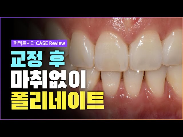 마취없이 치아성형 가능한 CASE 💉 | 최대 0.2mm 폴리네이트