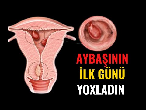 Video: Menorragiyanın əlamətləri və əlamətləri hansılardır?