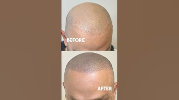 Failed hair transplant corrected using Scalp Micropigmentation! #shortsviral #wow #hairloss