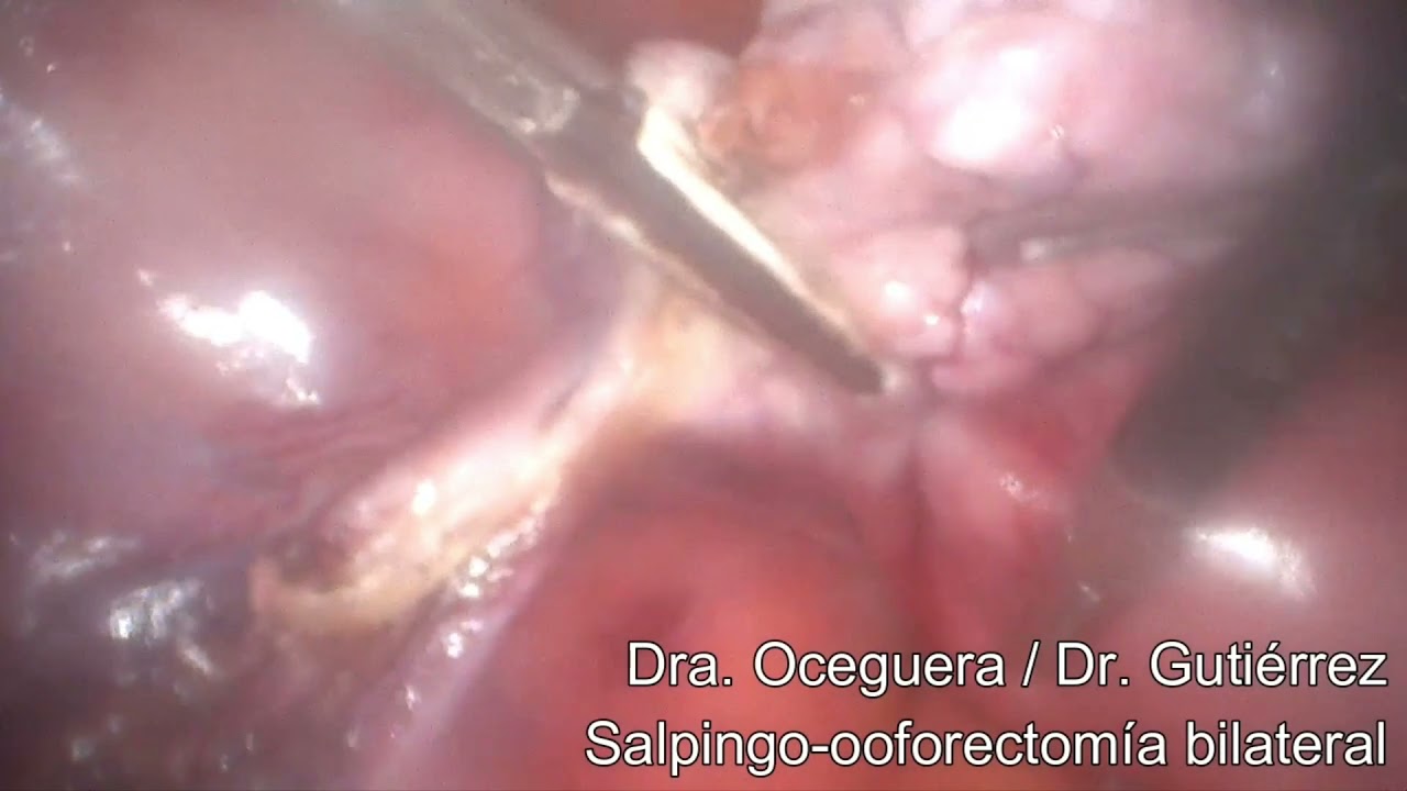 Ooforectomía de salpingo bilateral •
