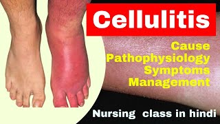 cellulitis nursing lecture in hindi | cause, symptoms, treatment | skin disease | msn screenshot 4