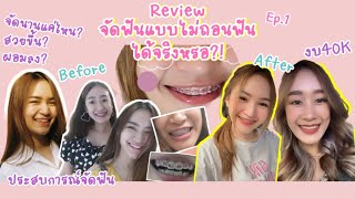 จัดฟันไม่ถอนฟัน แก้ฟันสบลึกในงบ4หมื่น ได้จริงหรอ?! - Ep.1