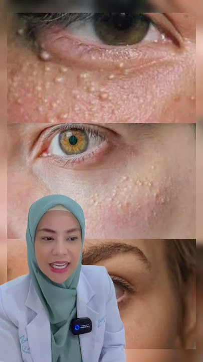Muncul bintik putih di sekitar mata 😍 #skincare #pemutih #makeuptutorial #skincareroutine #glowing