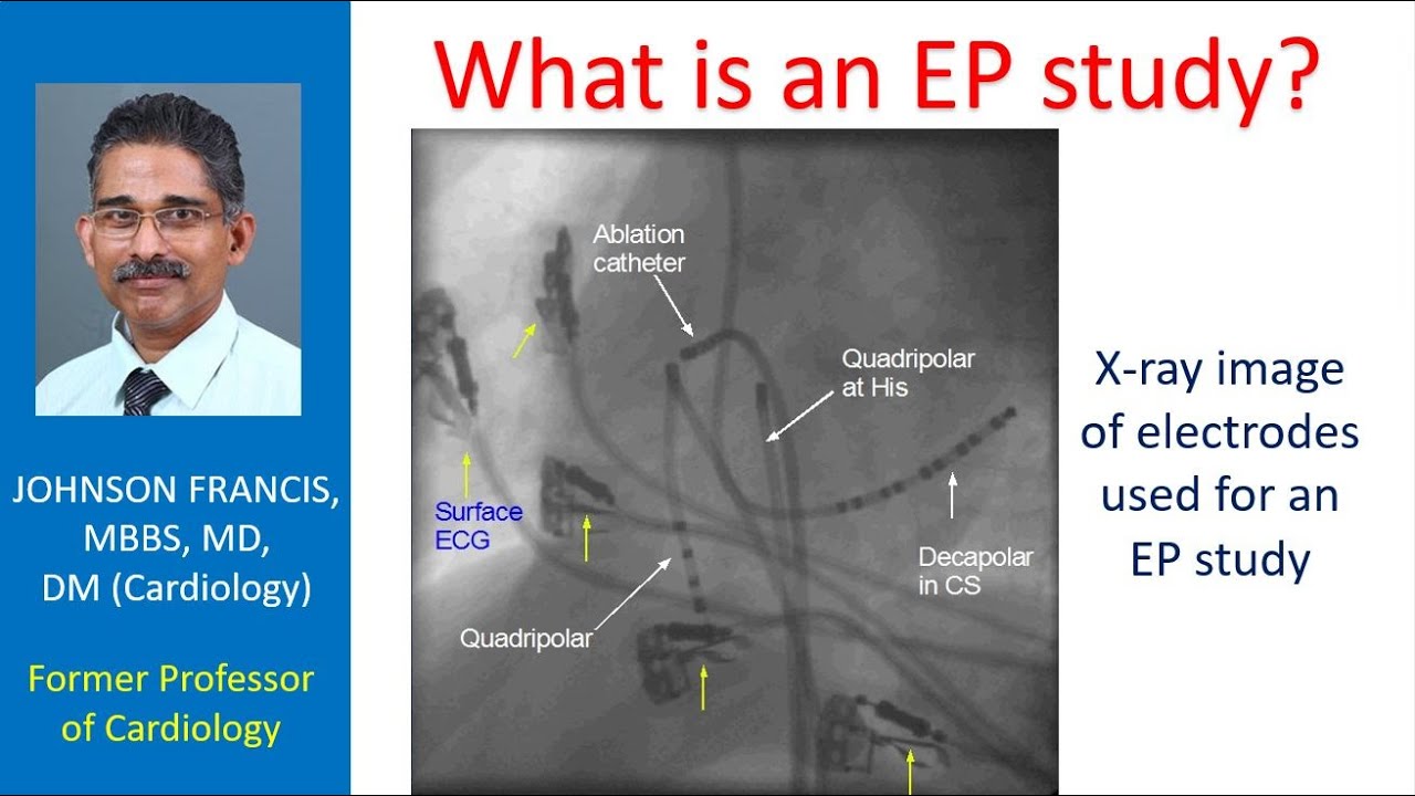 What is an EP study? - YouTube