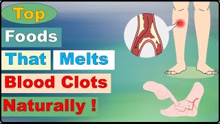 Top Foods That Melt Blood Clots Naturally l Foods that dissolve blood clot l blood clots treatment