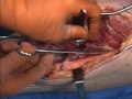 Fasciotomy Lower Limb