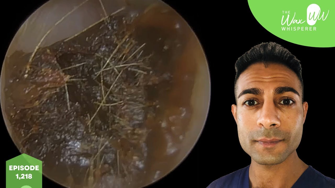 1,218 Head Injury Ear Wax Removal in Fractured Ear Canal YouTube