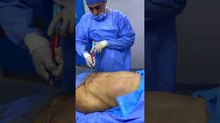 شاهد عملية شد البطن وشفط الدهون  | Abdominoplasty | د.ياسر بادى