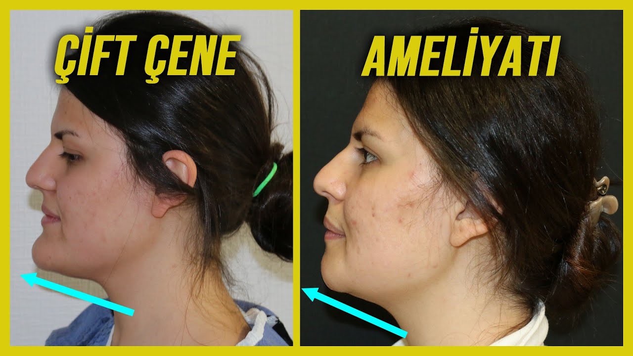 Esteport / Çift Çene Estetiği Oldum! - Op.Dr.Ali Mezdeği