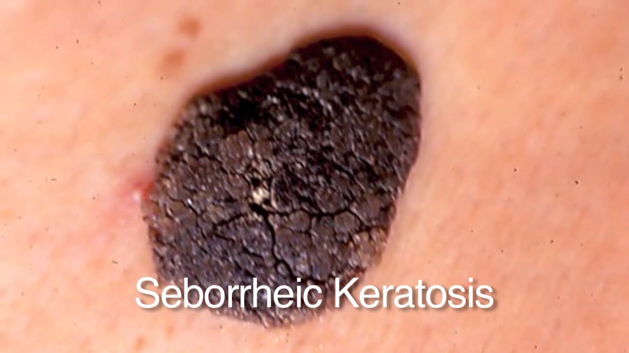 Golden State Dermatology Common Benign Growths Youtube