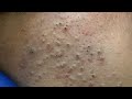 Aggressive Blackheads Removal Restores a Completely Congested Skin