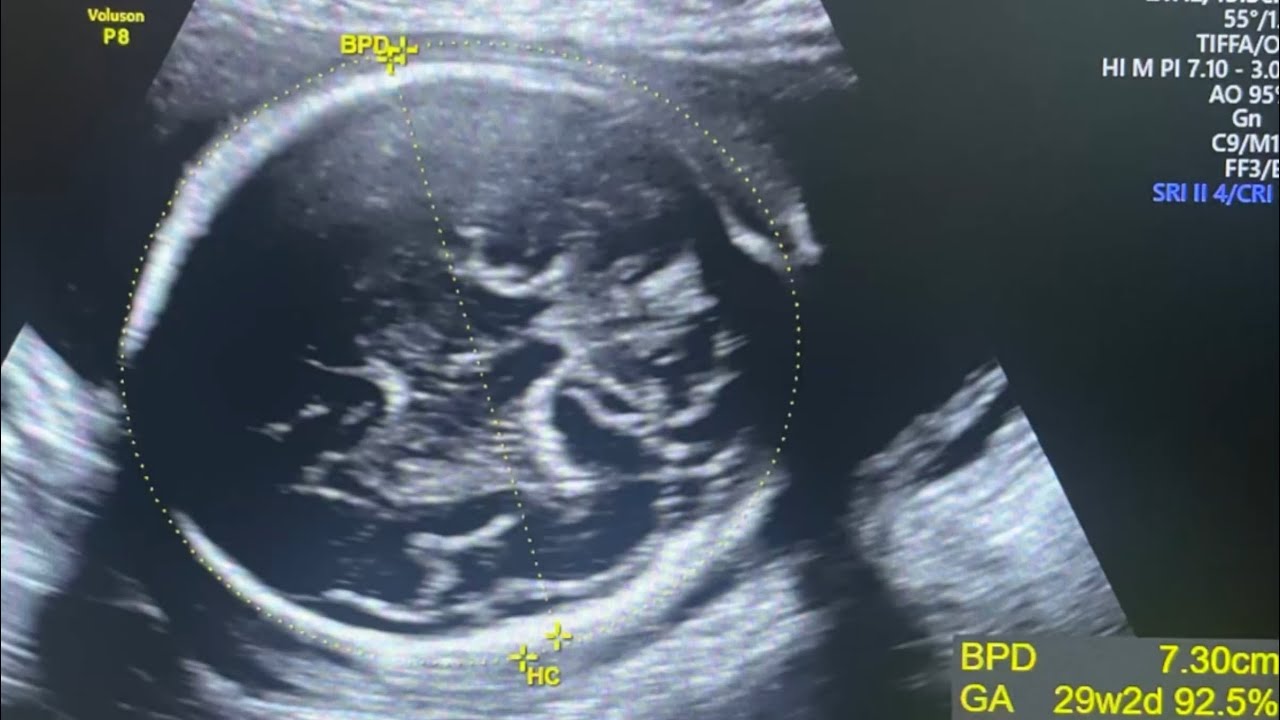 Interval Growth scan in pregnancy .. how we do #AthreyaHospital - YouTube