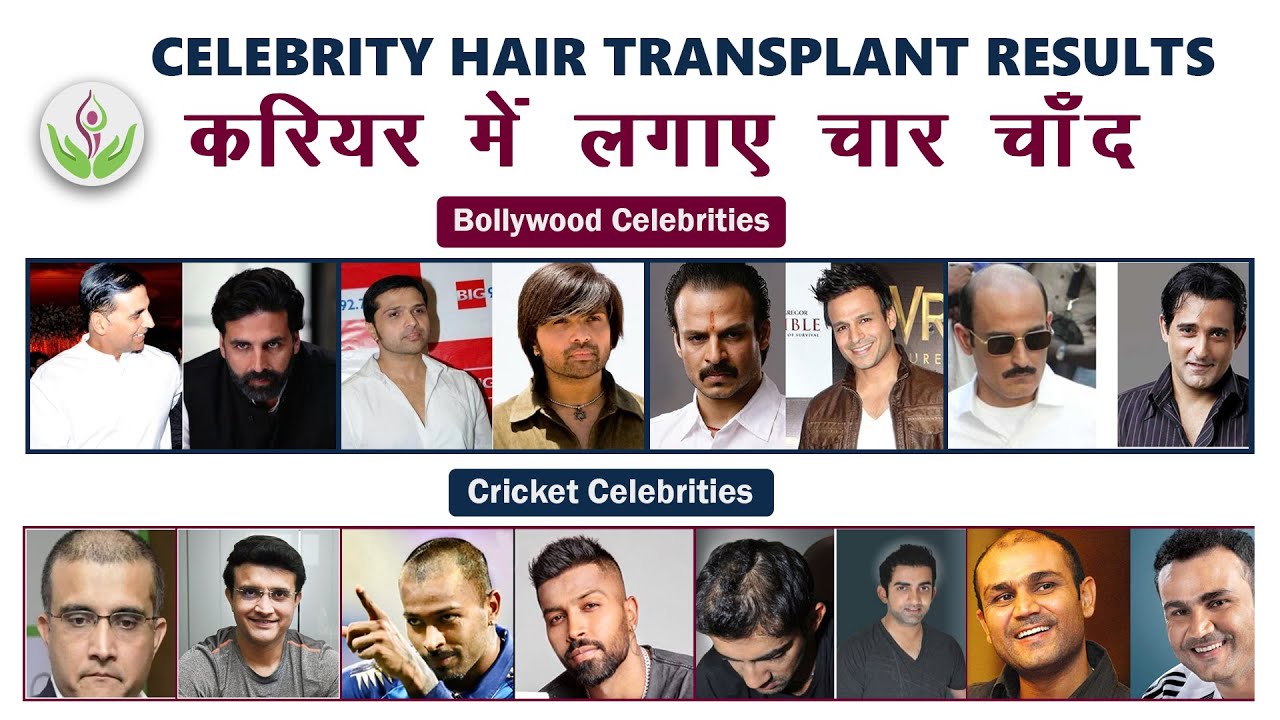 SHOCKING 5 Bollywood actors who underwent hair transplant