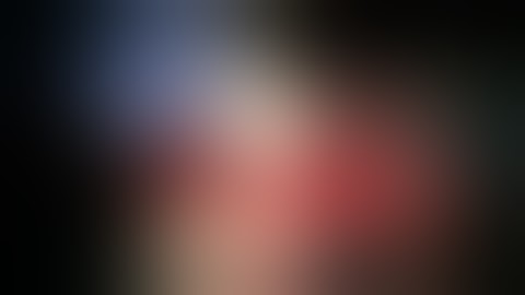 EXPOSED ELBOW JOINT TREATED BY LAT. DORSI MS. AXIAL PATTERN FLAP.BY PROF. RIDA FRANKA