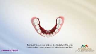 Orthodontic Expander or Spacer - Lower Schwartz Appliance