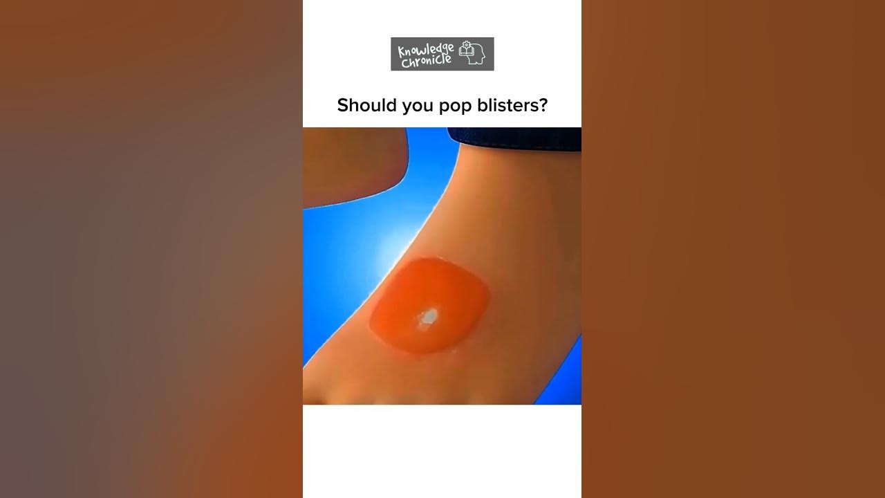 Should You Pop Blisters Hand Foot Mouth Disease