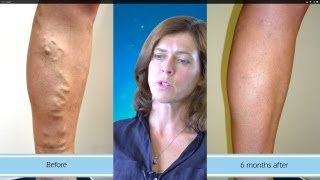 Amazing Results from Varicose Vein Surgery