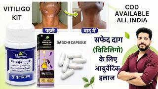 Vitiligo (Safed Daag) Treatment in Ayurveda | Swayambhuva Guggul | BAKUCHI OIL | Leucoderma