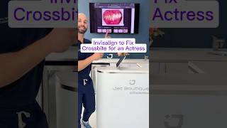 Adult Invisalign Crossbite Fix Before &amp; Progress | Actress Smile Transformation
