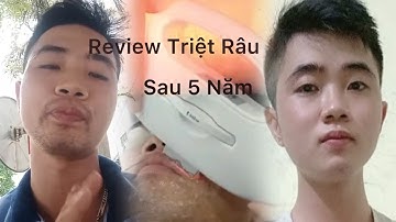 Review Triệt Râu -Sau 5 năm giờ đây như thế nào? Triệt lông vĩnh viễn