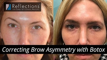 Correcting Asymmetry with Botox [Balance Out Uneven Brows] with Dr. Mitchell Chasin