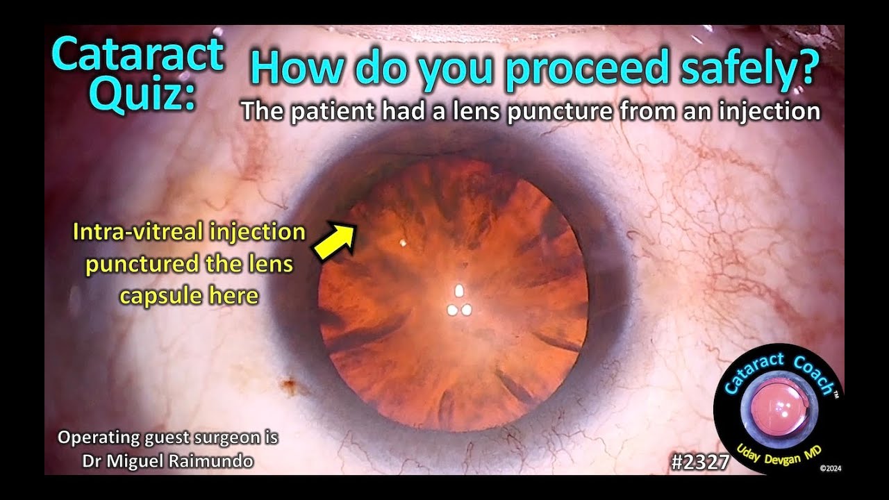 CataractCoach™ 2327: Cataract Quiz: How do you proceed safely? Intra ...