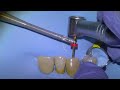 [18] Root canal procedure on infected canine tooth