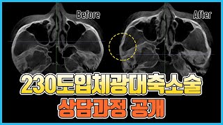 ⭐️230도입체광대축소술⭐️ 상담과정 공개! (옆광대 축소, 45도광대 쉐이빙)